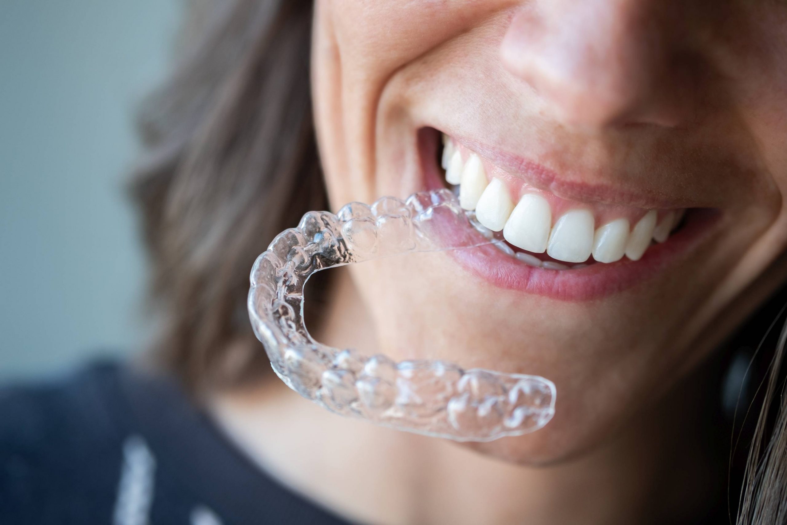 Invisalign dans la bouche d'une patiente souriante, représentant l'orthodontie moderne pour des sourires éclatants.