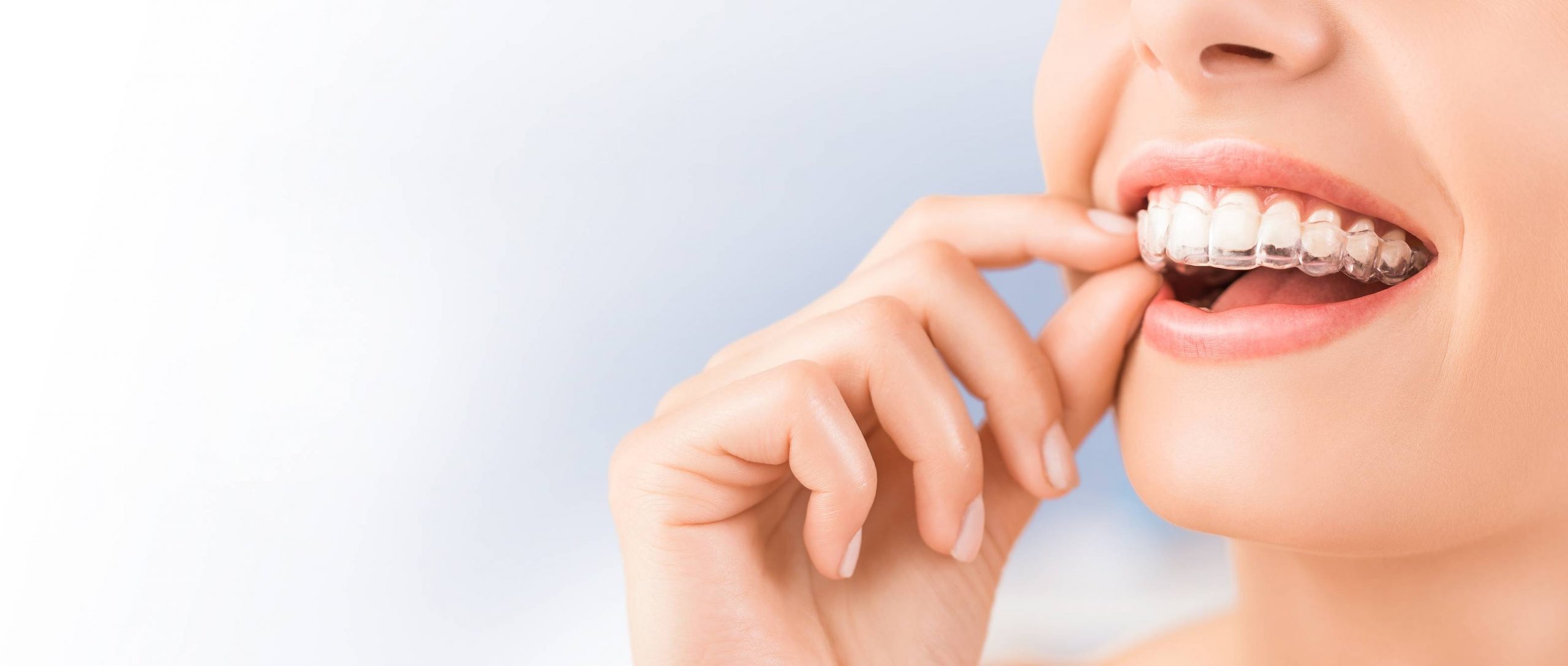 Femme souriante portant un aligneur transparent, symbolisant des soins orthodontiques modernes pour un sourire éclatant.